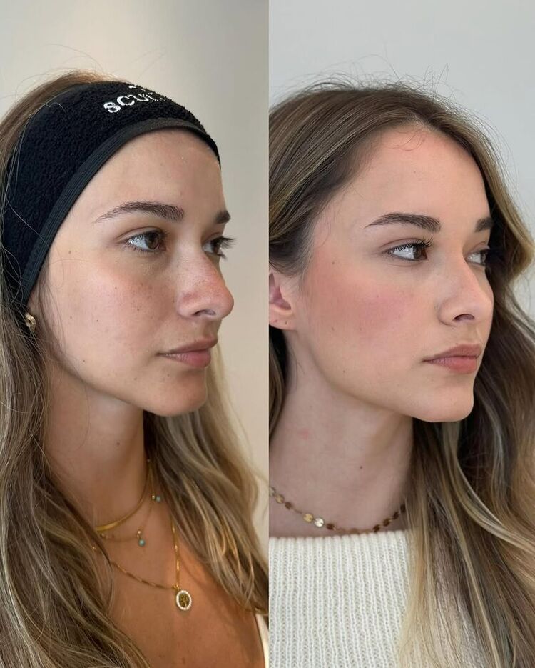 Resultado: Harmonização Full Face - Traços suavizados com harmonia e delicadeza