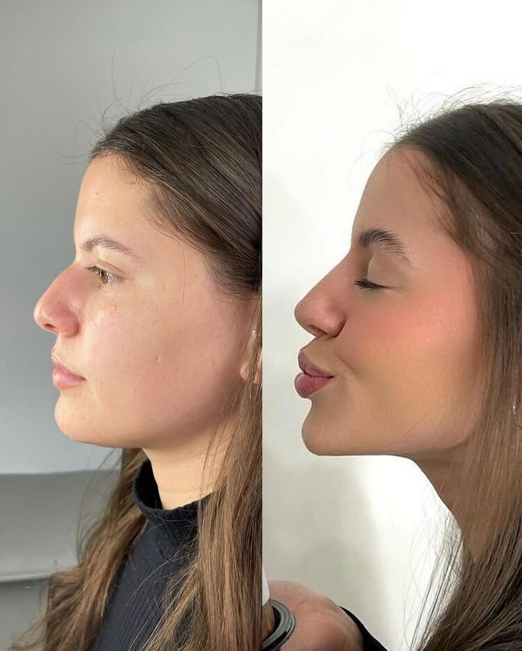 Resultado: Full Face + Lábios - Lábios definidos e contorno facial mais equilibrado