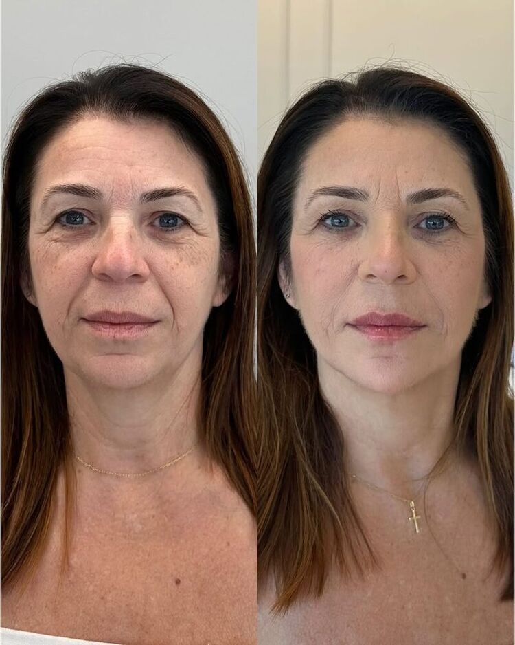 Resultado: Rejuvenescimento Facial - Pele com mais viço e contorno revitalizado