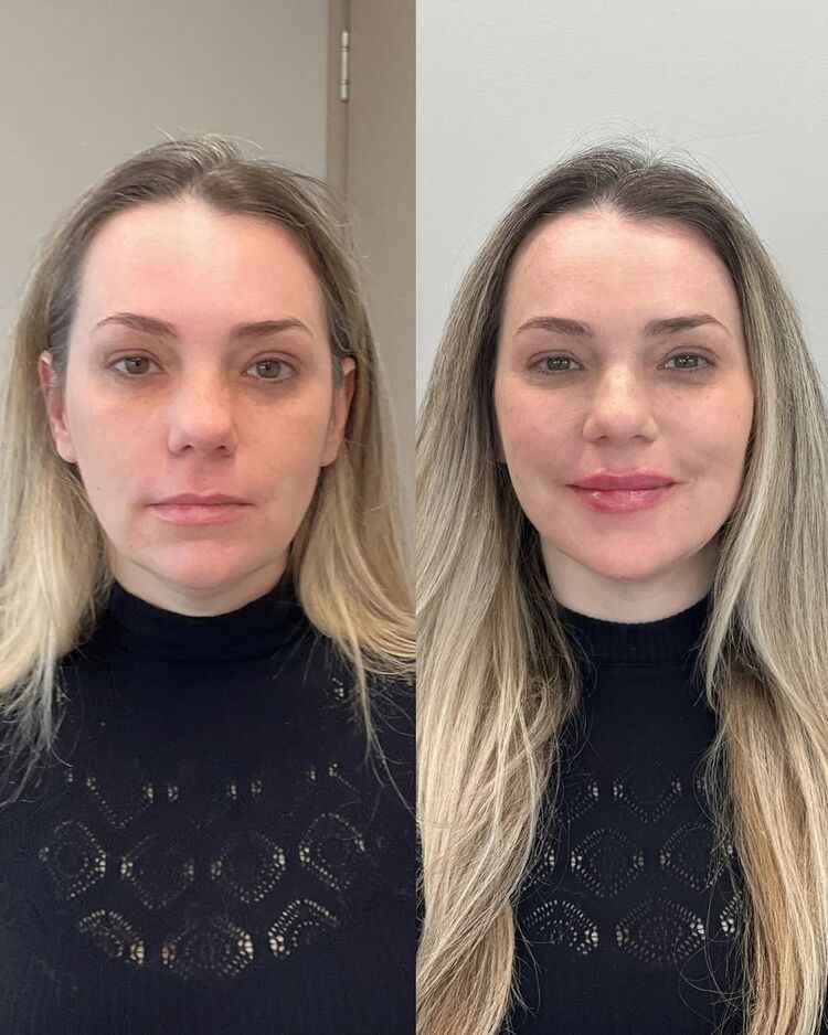 Resultado: Harmonização Full Face - Beleza natural realçada com equilíbrio e sensibilidade